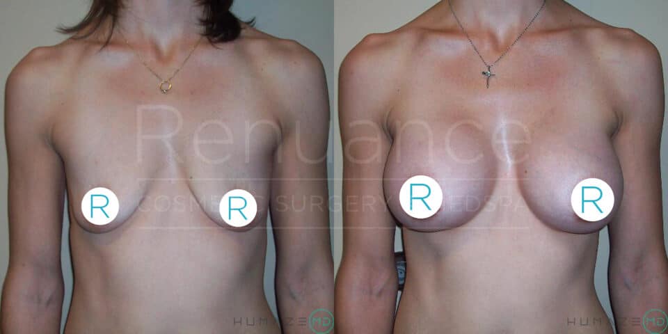 Before and after photo of a person's torso showing the results of breast augmentation. The left image shows a flat chest, while the right image shows a fuller chest after surgery. The nipples are covered with circular markers labeled "R."