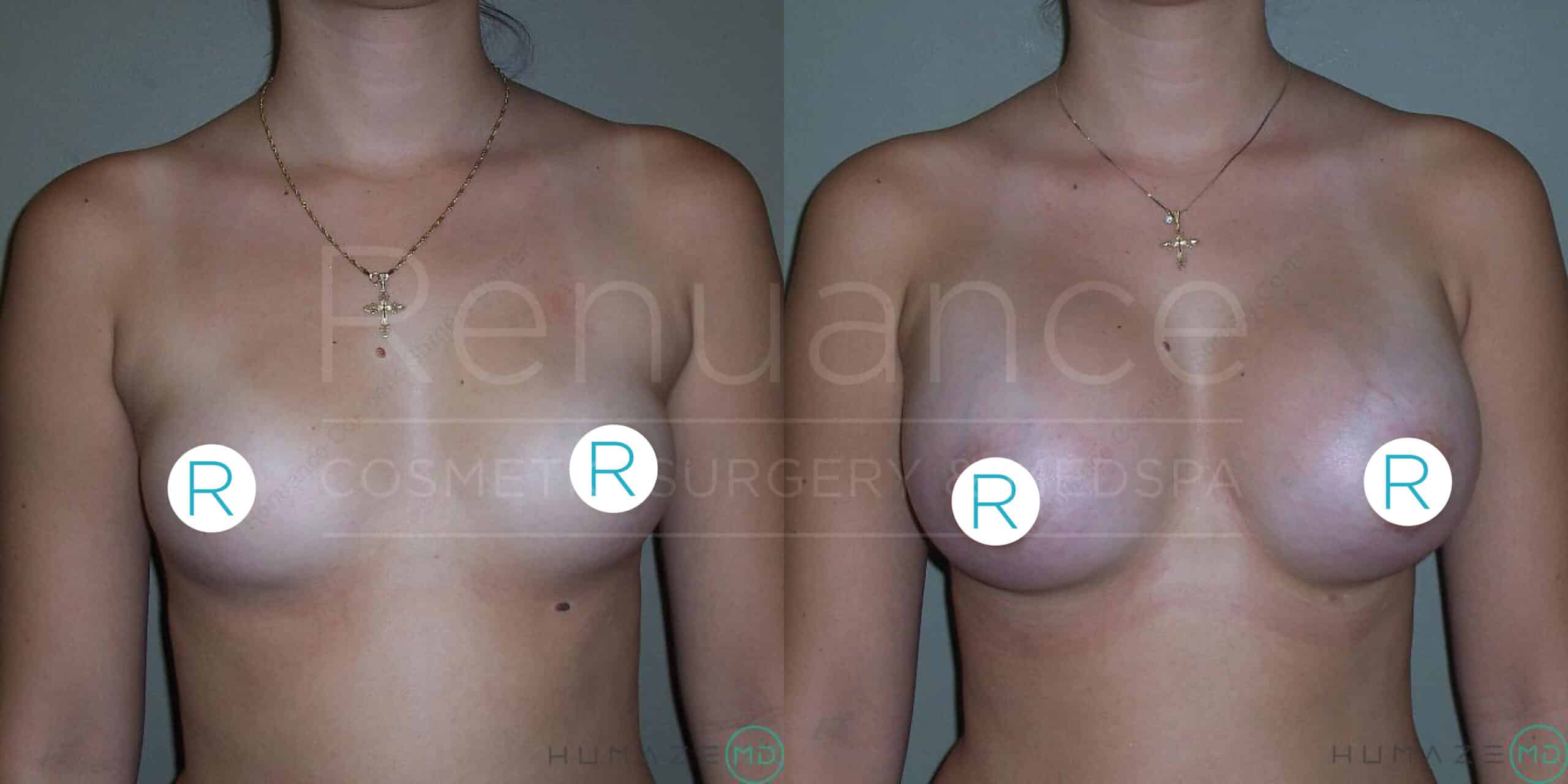 A side-by-side comparison image of a person's upper body showing the results of breast augmentation surgery. The image on the left shows the person before the surgery, and the image on the right shows the person after the surgery with visibly larger and fuller breasts. Both images have white circles with the letter "R" on the chest area, and the background features the text "Renuance COSMETIC SURGERY & MEDSPA" in a semi-transparent overlay.
