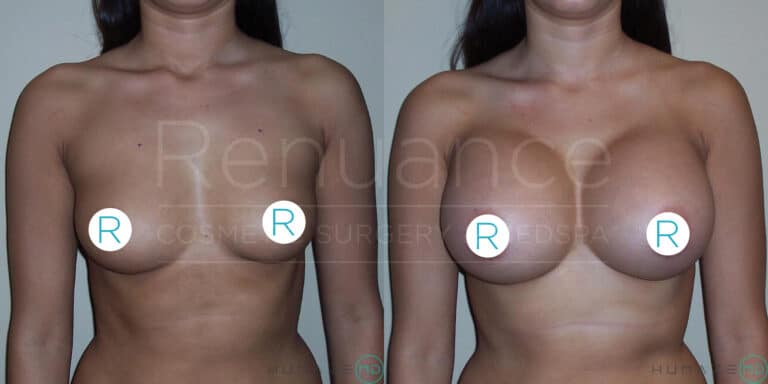 "Before and after comparison of a woman showing the results of breast augmentation surgery, with noticeable changes in breast size and shape. The woman is facing forward in both images, covering her nipples with "R" circles. 'Renuance Cosmetic Surgery Center' watermark is visible across the image."