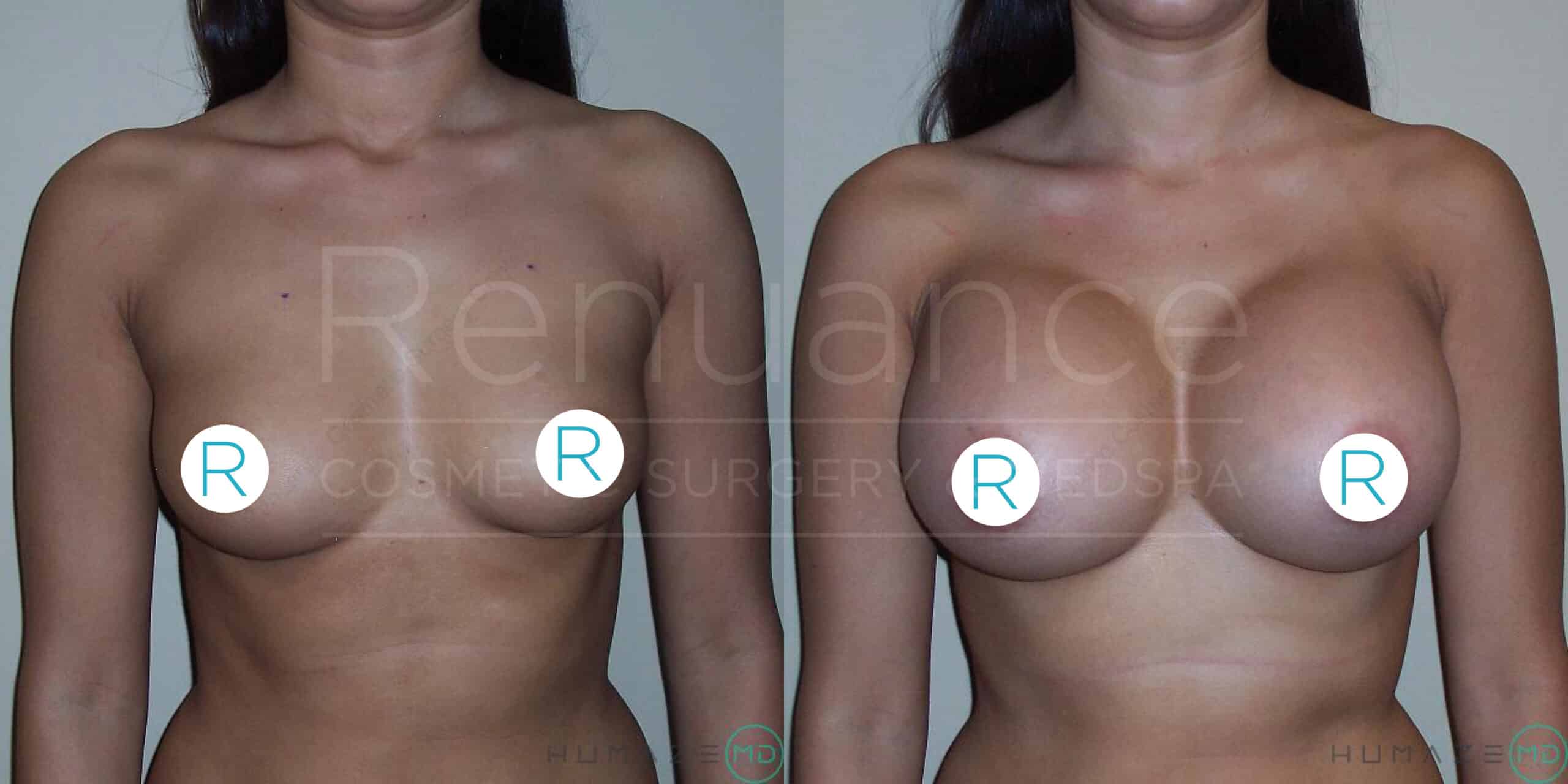 "Before and after comparison of a woman showing the results of breast augmentation surgery, with noticeable changes in breast size and shape. The woman is facing forward in both images, covering her nipples with "R" circles. 'Renuance Cosmetic Surgery Center' watermark is visible across the image."