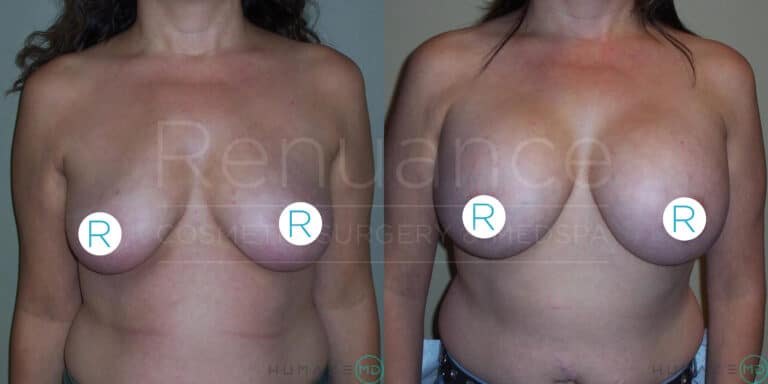 Before and after side-by-side images of a woman's chest showing the results of a cosmetic breast procedure. The left image displays the person's breasts prior to the procedure, and the right image shows the person’s enhanced breast size and shape post-procedure. Circular stickers with the letter "R" cover the nipples for modesty. The logo "Renuance Cosmetic Surgery Center & …" is faintly visible over the images.