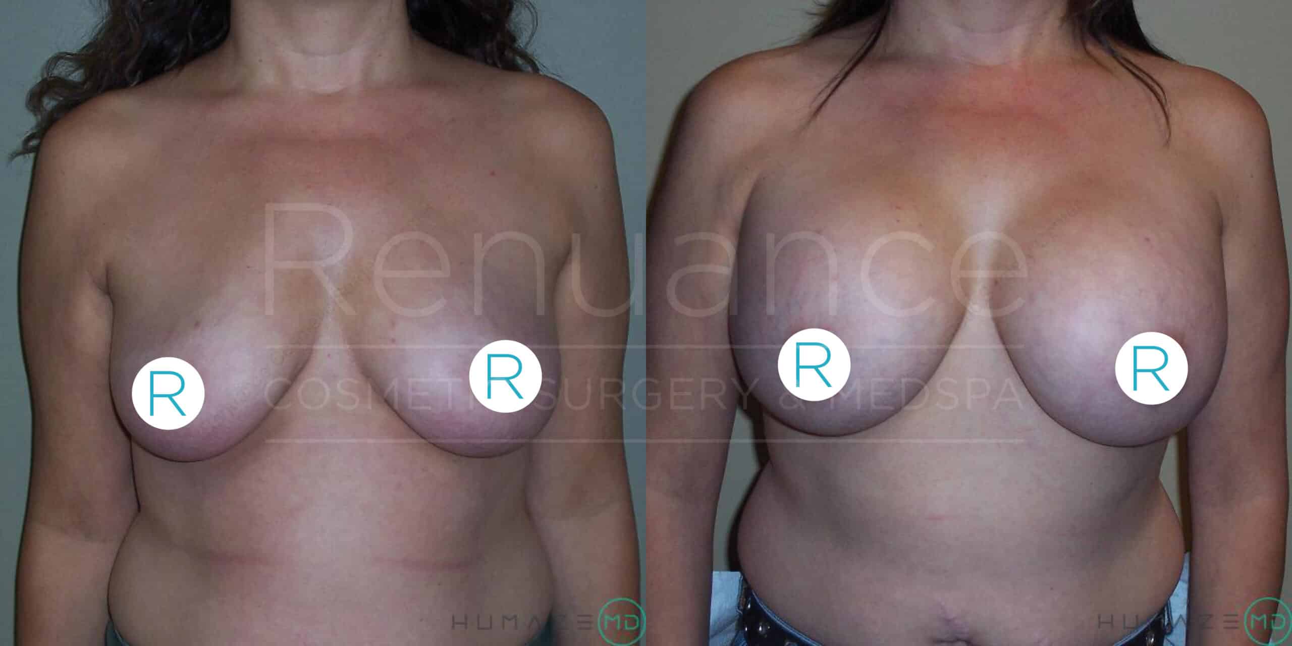 Before and after side-by-side images of a woman's chest showing the results of a cosmetic breast procedure. The left image displays the person's breasts prior to the procedure, and the right image shows the person’s enhanced breast size and shape post-procedure. Circular stickers with the letter "R" cover the nipples for modesty. The logo "Renuance Cosmetic Surgery Center & …" is faintly visible over the images.