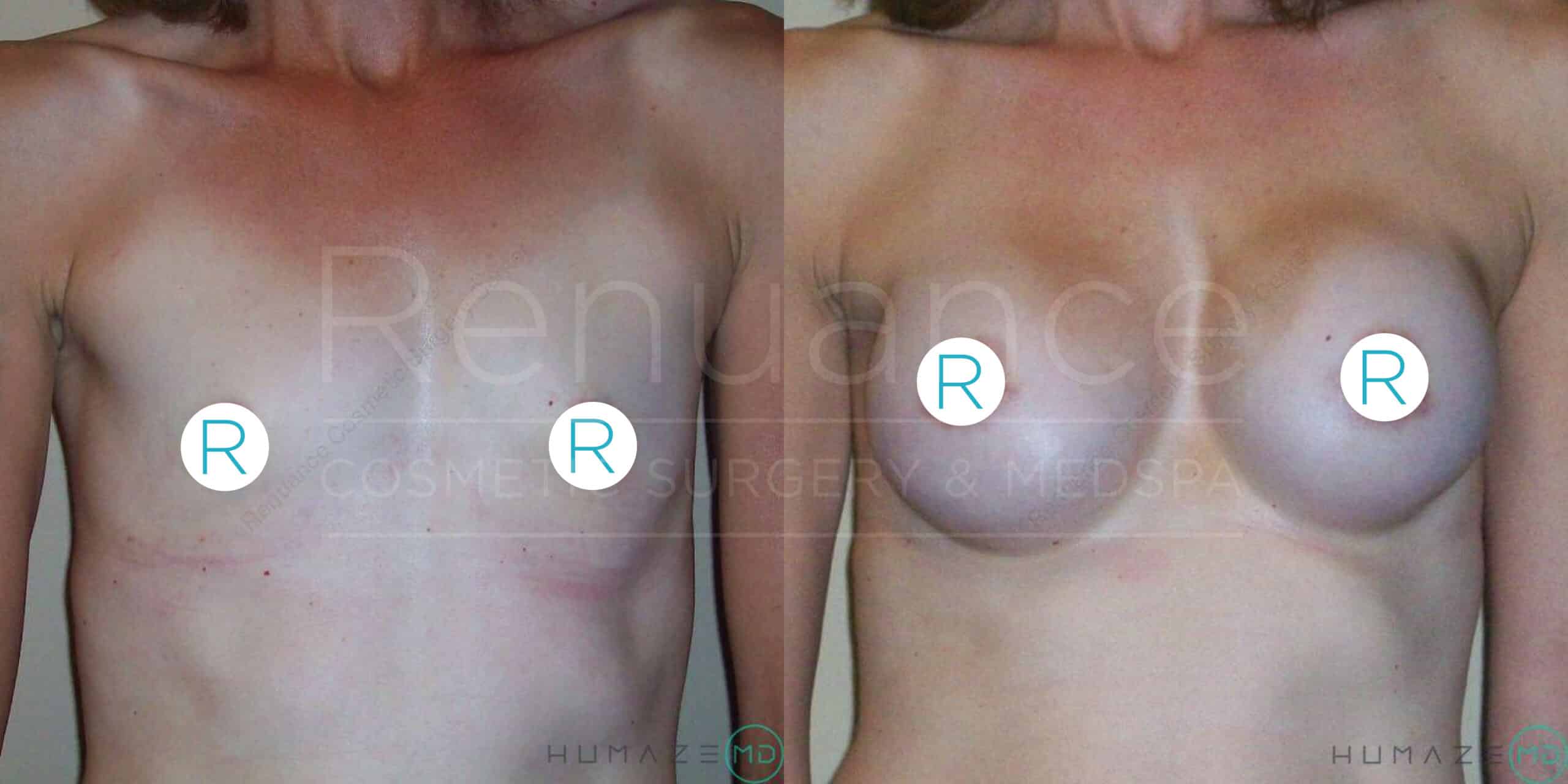 Before and after images of a person's chest showing the results of breast augmentation surgery. The left image shows the chest before surgery with smaller breasts, and the right image shows the chest after surgery with larger breasts. Both images have circular stickers labeled "R" covering the nipples. The background has text partially visible that reads "Renaissance Cosmetic Surgery & MedSpa".