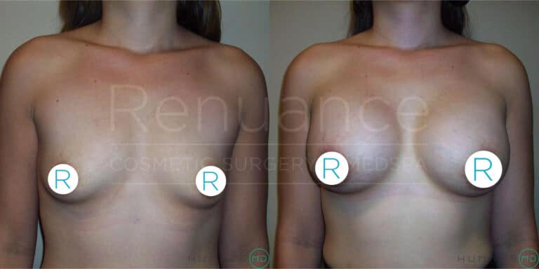 A before and after image showing the results of breast augmentation surgery. The left side displays a woman's chest with smaller and less pronounced breasts, while the right side shows the same woman with noticeably larger and fuller breasts. Both images include circular markers with the letter "R" on each breast, likely indicating the right side. The background text "Renuance COSMETIC SURGERY MED SPA" is faintly visible. The lighting and angle in both images appear consistent.