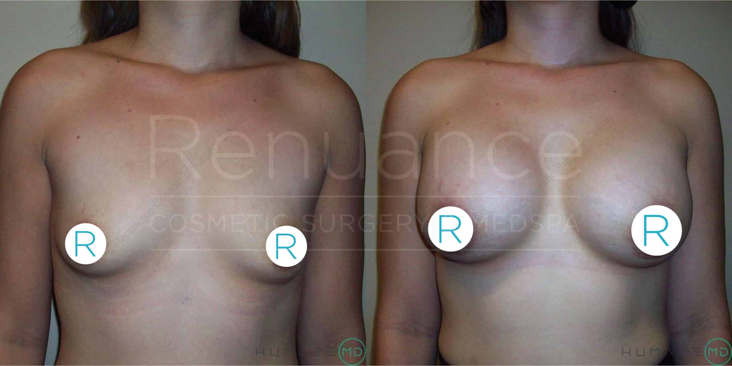 A before and after image showing the results of breast augmentation surgery. The left side displays a woman's chest with smaller and less pronounced breasts, while the right side shows the same woman with noticeably larger and fuller breasts. Both images include circular markers with the letter "R" on each breast, likely indicating the right side. The background text "Renuance COSMETIC SURGERY MED SPA" is faintly visible. The lighting and angle in both images appear consistent.