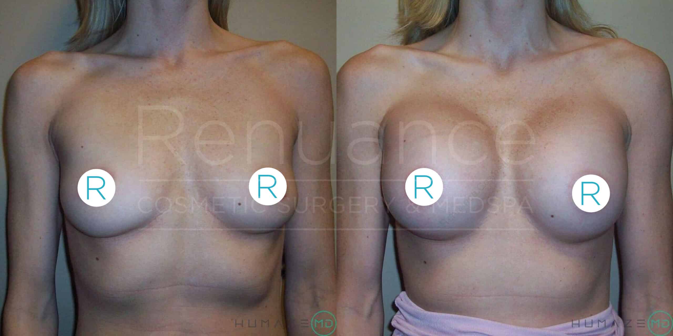 Comparison image of a woman's chest showing the results of a breast augmentation surgery, with a "before" on the left and an "after" on the right. Both images have circular labels with the letter "R" over the nipples, and "Renuance Cosmetic Surgery & Med Spa" text in the background. The "after" image shows increased breast size and enhanced contour.