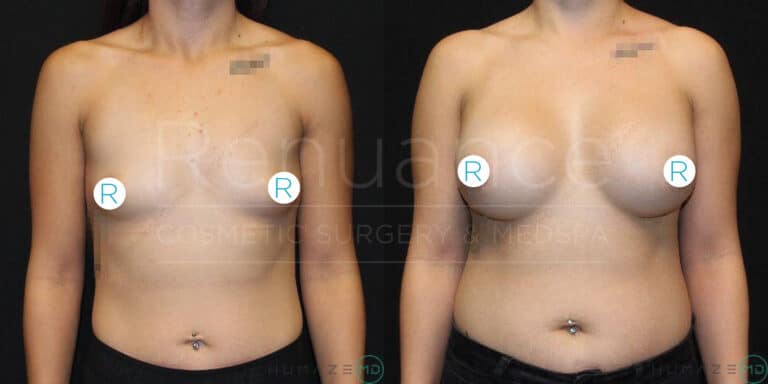 A before-and-after image showing the results of a cosmetic breast enhancement surgery. The image on the left displays a person's chest before the procedure with smaller and differently shaped breasts. The image on the right shows the same person's chest after the procedure, with larger and more symmetrical breasts.