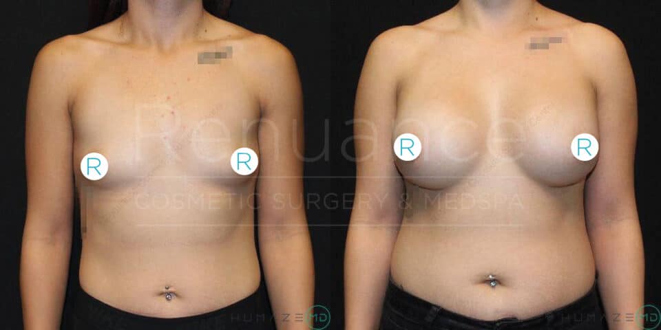 A before-and-after image showing the results of a cosmetic breast enhancement surgery. The image on the left displays a person's chest before the procedure with smaller and differently shaped breasts. The image on the right shows the same person's chest after the procedure, with larger and more symmetrical breasts.