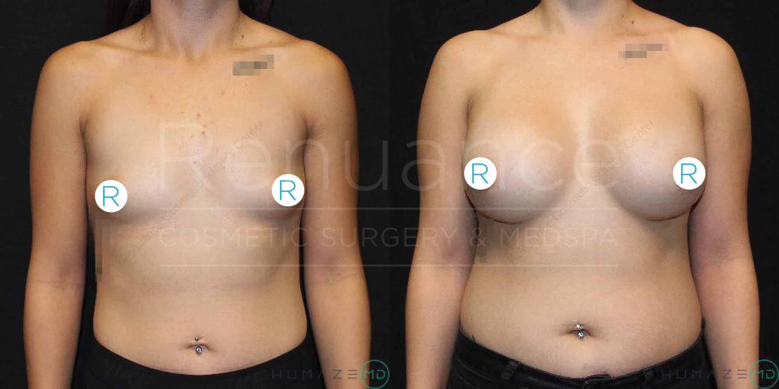 A before-and-after image showing the results of a cosmetic breast enhancement surgery. The image on the left displays a person's chest before the procedure with smaller and differently shaped breasts. The image on the right shows the same person's chest after the procedure, with larger and more symmetrical breasts.