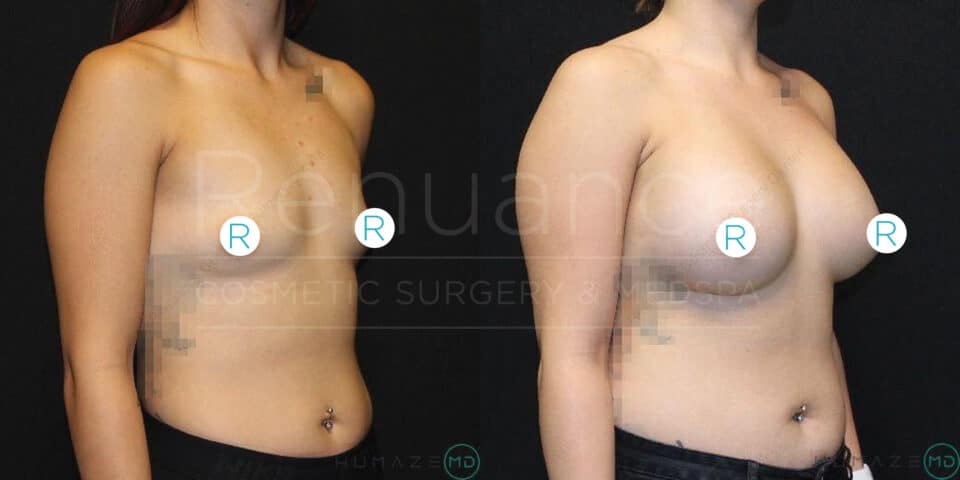 A before-and-after image showing the results of a breast augmentation procedure. The left side of the image shows a woman’s chest before surgery, while the right side shows the same woman's chest after the surgery, with visibly larger breasts. The images have been partially obscured for privacy, and there is a logo and text in the background mentioning "Renue" and "COSMETIC SURGERY & MEDSPA."