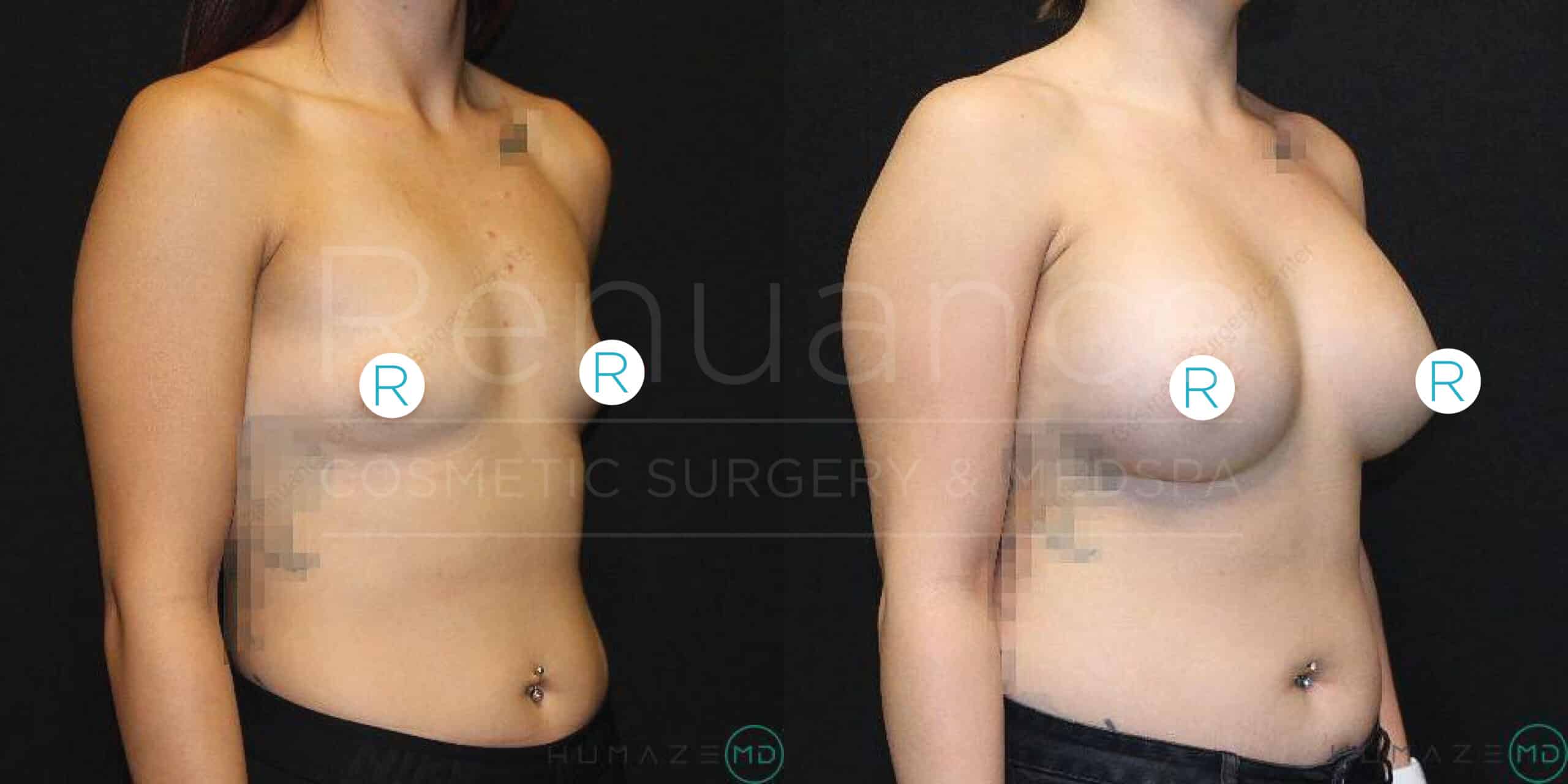 A before-and-after image showing the results of a breast augmentation procedure. The left side of the image shows a woman’s chest before surgery, while the right side shows the same woman's chest after the surgery, with visibly larger breasts. The images have been partially obscured for privacy, and there is a logo and text in the background mentioning "Renue" and "COSMETIC SURGERY & MEDSPA."