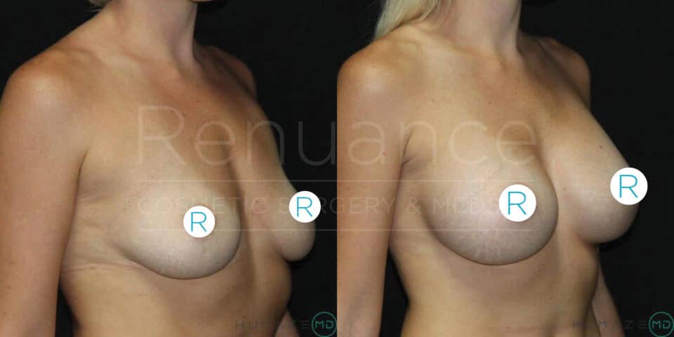 A side-by-side comparison of a woman's upper torso, illustrating the results before and after breast augmentation surgery. The left image shows the woman's chest prior to the procedure, with natural breast contours. The right image shows the woman's chest after the procedure, displaying enlarged and more rounded breasts. Discrete circular labels with the letter "R" cover the nipples in both images. The background is dark, and the text "Renuance Cosmetic Surgery & Med" is faintly visible across both images.