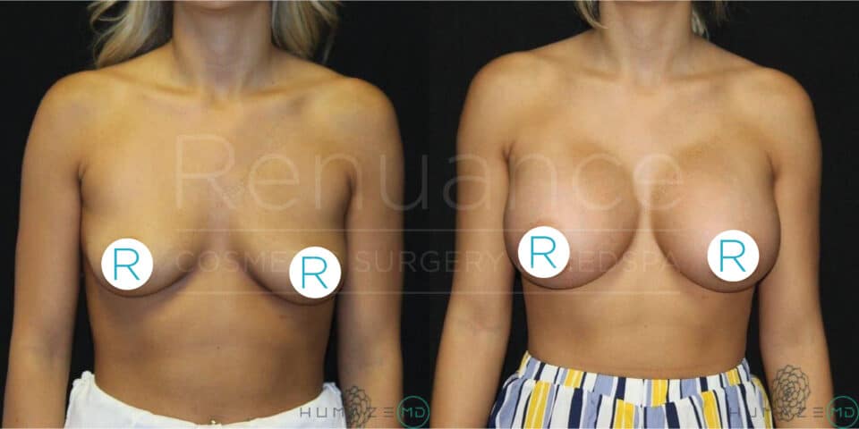 A side-by-side comparison image showing the upper torso of a person before and after breast augmentation surgery. The left side shows the person before the procedure, and the right side shows the person after the procedure with noticeable enhancements. The background is solid black. The text "Renuance COSMETIC SURGERY CENTER" is faintly visible in the middle of the image. The letters "R" overlay the person’s nipples and private areas for privacy. The person is wearing striped pants and is topl