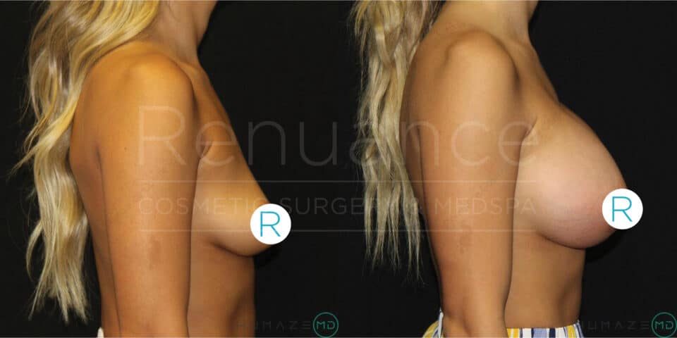 Side-by-side comparison of a woman's torso before and after breast augmentation surgery. The left image shows a profile view of her breasts before surgery, while the right image shows a profile view with noticeably larger breasts after the procedure. Both images have "R" labels near the breasts, indicating the right side. The background is dark, and text "Renuance COSMETIC SURGERY MEDSPA" is faintly visible across the images.