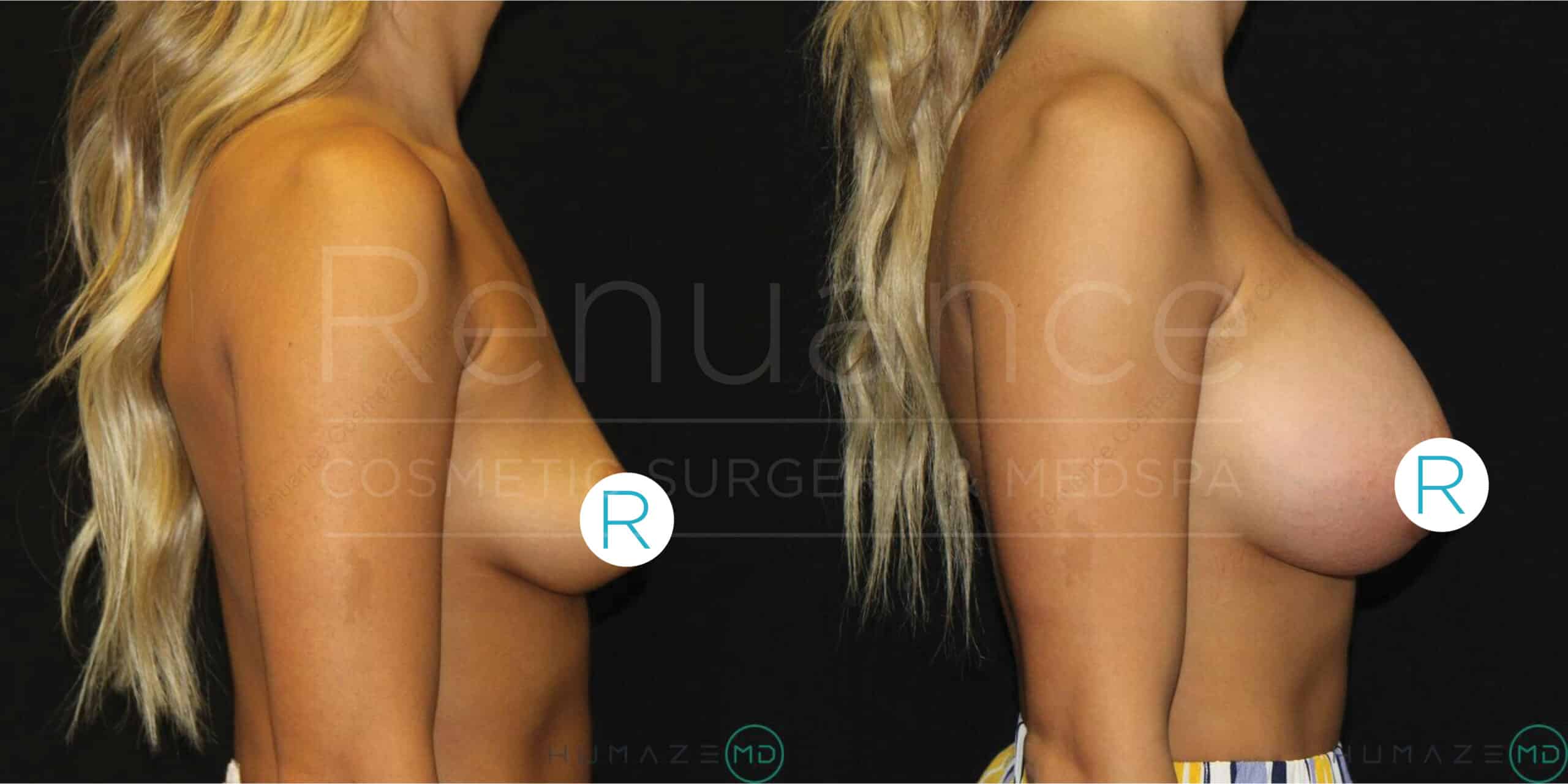 Side-by-side comparison of a woman's torso before and after breast augmentation surgery. The left image shows a profile view of her breasts before surgery, while the right image shows a profile view with noticeably larger breasts after the procedure. Both images have "R" labels near the breasts, indicating the right side. The background is dark, and text "Renuance COSMETIC SURGERY MEDSPA" is faintly visible across the images.