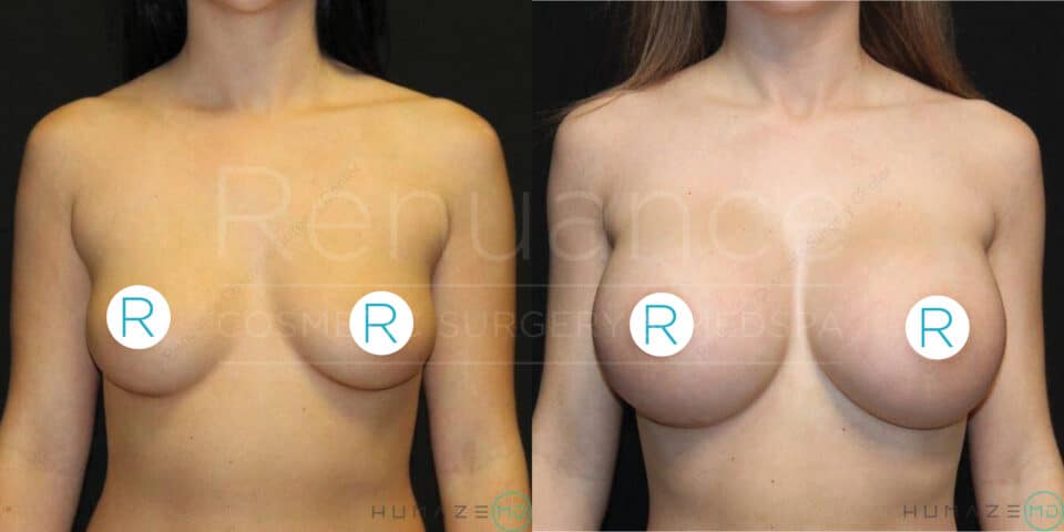 A side-by-side comparison image showing a woman's torso before and after breast augmentation surgery. The left side shows the woman before the procedure with smaller breasts, while the right side shows the woman after the procedure with larger, fuller breasts. Both images are taken against a dark background, and her nipples are covered by circular 'R' icons.