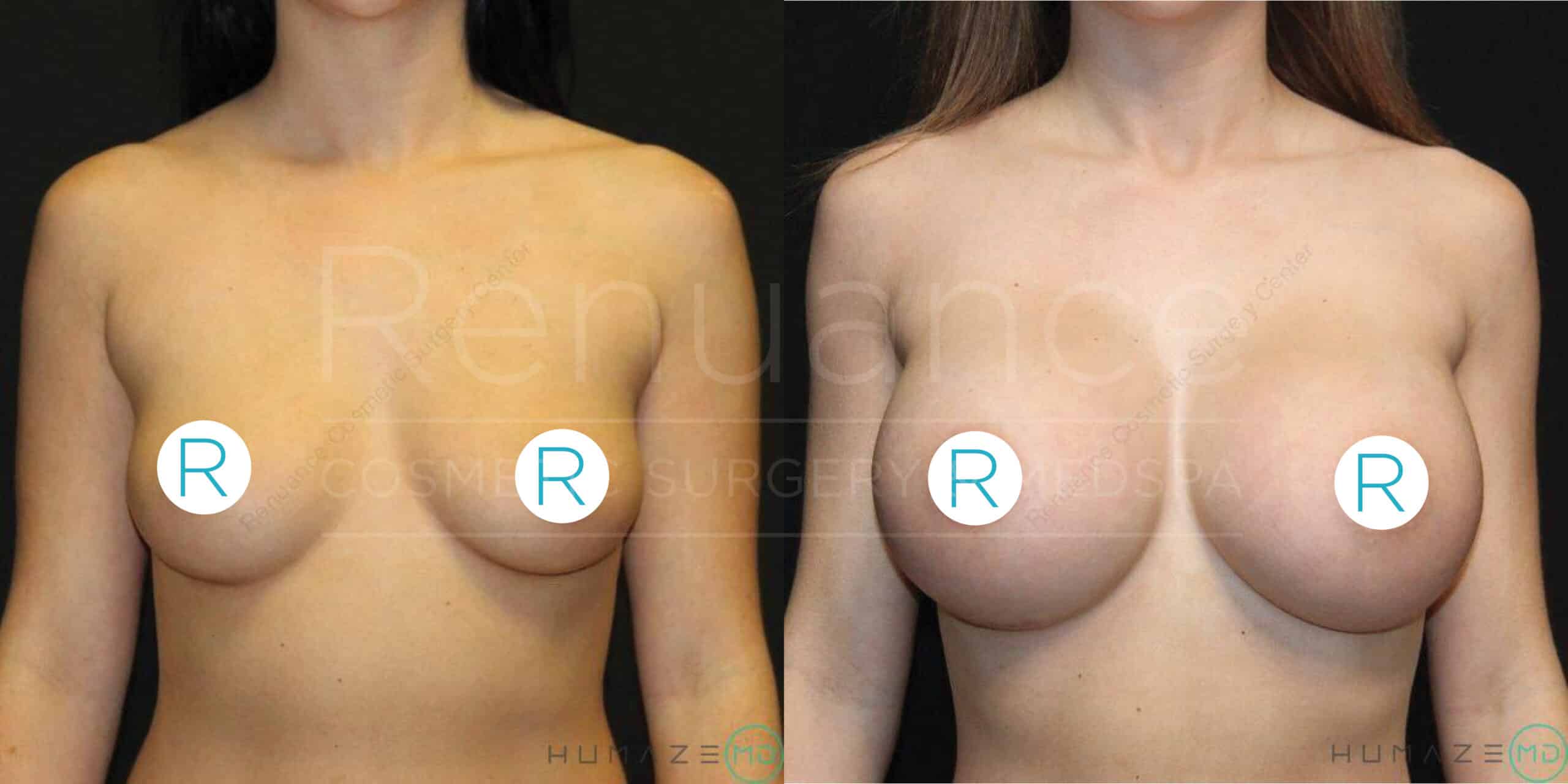 A side-by-side comparison image showing a woman's torso before and after breast augmentation surgery. The left side shows the woman before the procedure with smaller breasts, while the right side shows the woman after the procedure with larger, fuller breasts. Both images are taken against a dark background, and her nipples are covered by circular 'R' icons.