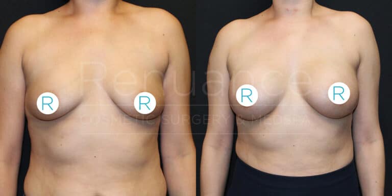 Before and after images showing the results of a cosmetic breast surgery. The left image is the "before" photo and shows a person with natural breasts. The right image is the "after" photo and shows the same person with enhanced, more symmetrical breasts following the procedure. There are white circles with the letter "R" over each nipple to indicate the right side.