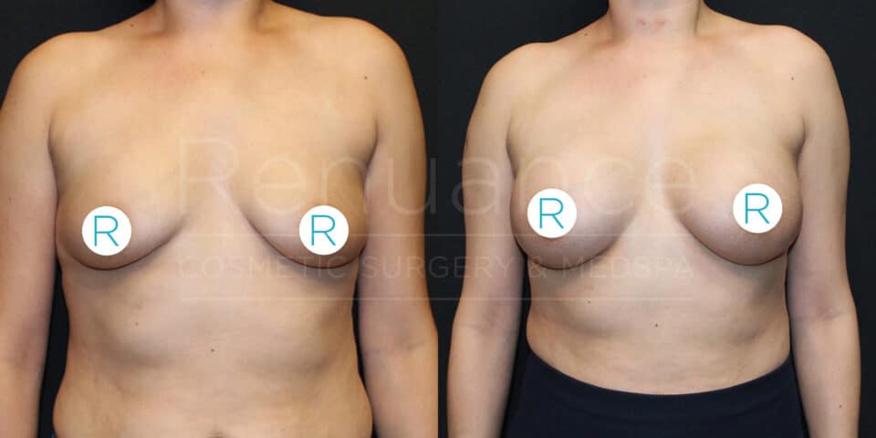 Before and after images showing the results of a cosmetic breast surgery. The left image is the "before" photo and shows a person with natural breasts. The right image is the "after" photo and shows the same person with enhanced, more symmetrical breasts following the procedure. There are white circles with the letter "R" over each nipple to indicate the right side.