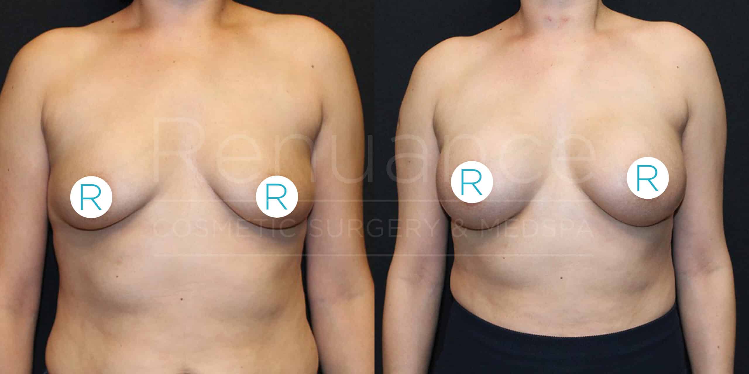 Before and after images showing the results of a cosmetic breast surgery. The left image is the "before" photo and shows a person with natural breasts. The right image is the "after" photo and shows the same person with enhanced, more symmetrical breasts following the procedure. There are white circles with the letter "R" over each nipple to indicate the right side.