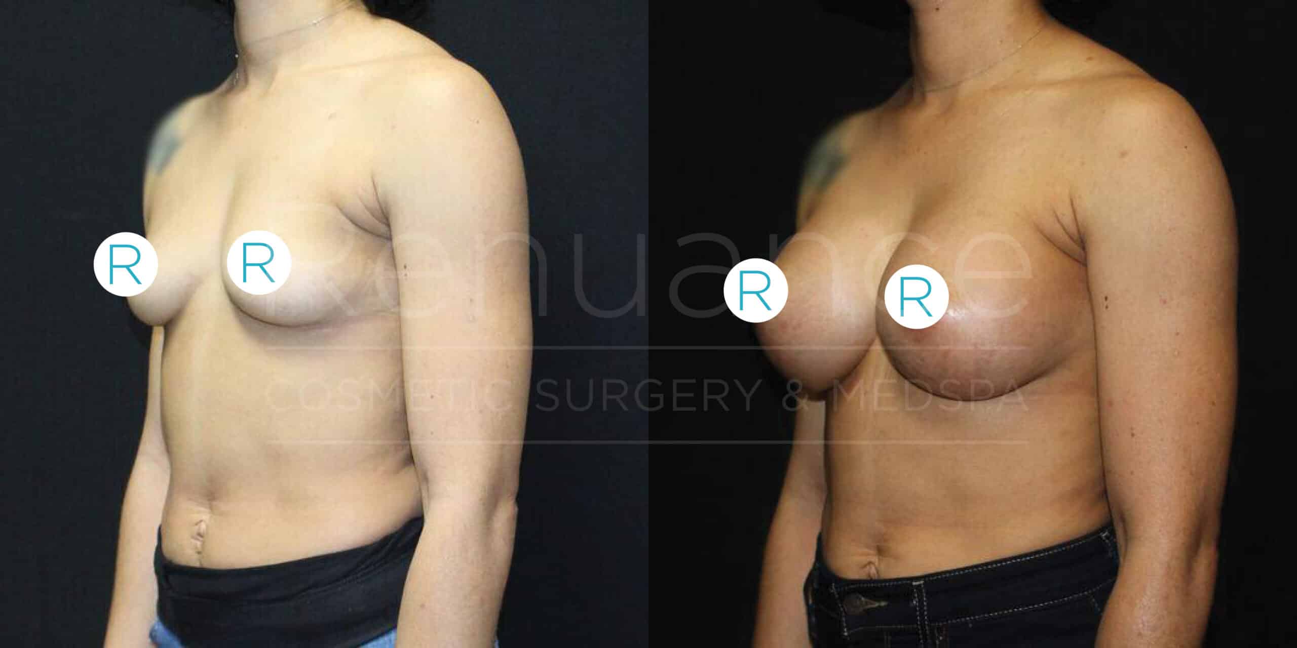 Side-by-side comparison of a woman's torso showing a before and after of cosmetic surgery. The left image shows the woman with smaller breasts and the right image shows her with larger, fuller breasts. Both images have labels with the letter "R" on her chest area to denote right side. The woman is wearing dark colored pants.