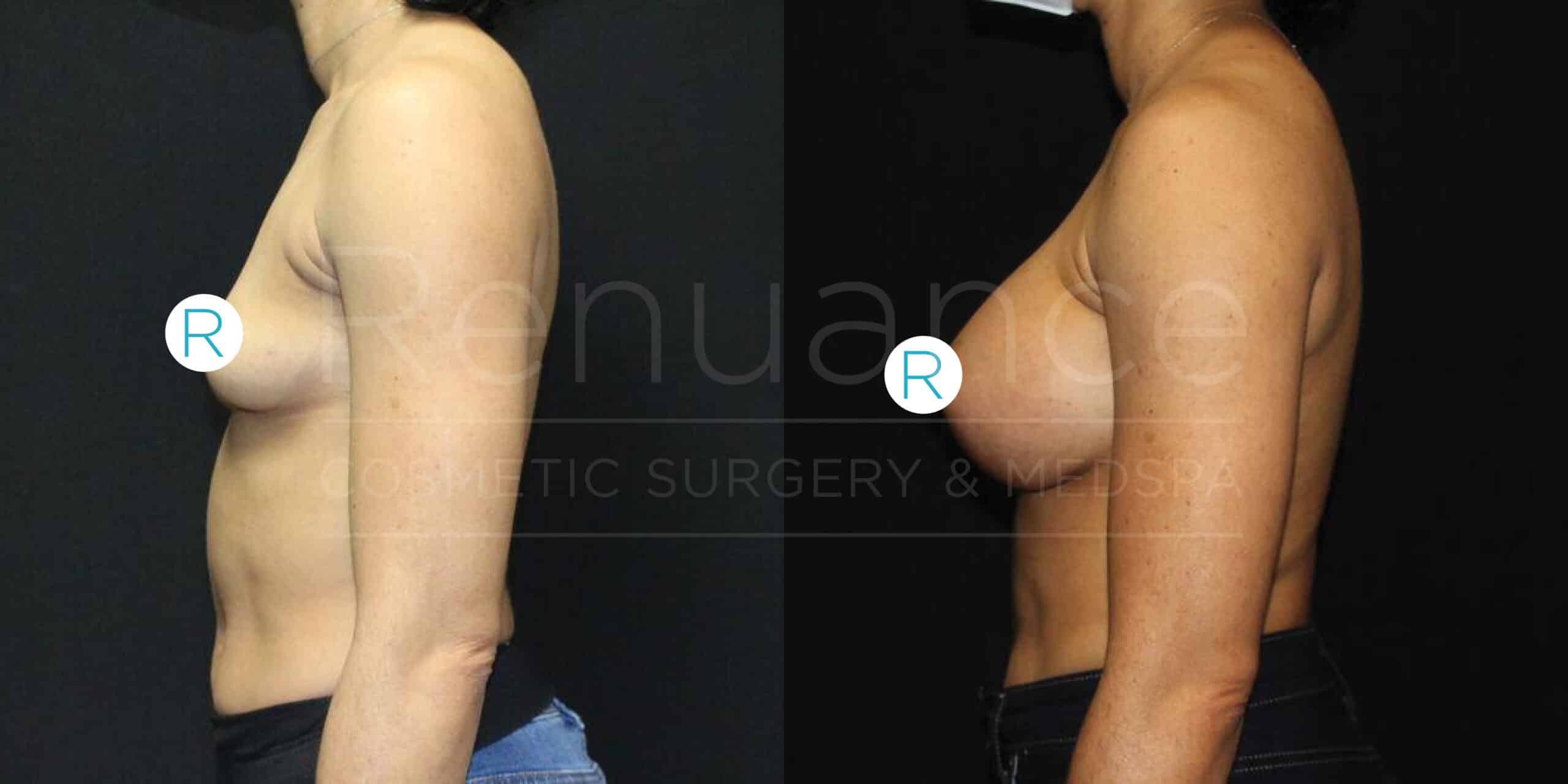 Side-by-side comparison image of the torso of a woman before and after a cosmetic surgery procedure showing increased breast size.