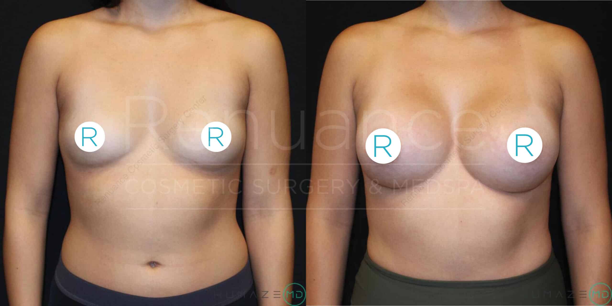 Side-by-side comparison of a woman's chest before and after breast augmentation surgery. The left side shows the "before" image with smaller, natural breasts, while the right side shows the "after" image with larger, more rounded breasts. Both images have circular markers labeled "R" placed over the nipple area. The background is black with faint text that appears to read "Resuance COSMETIC SURGERY & MEDSPA."