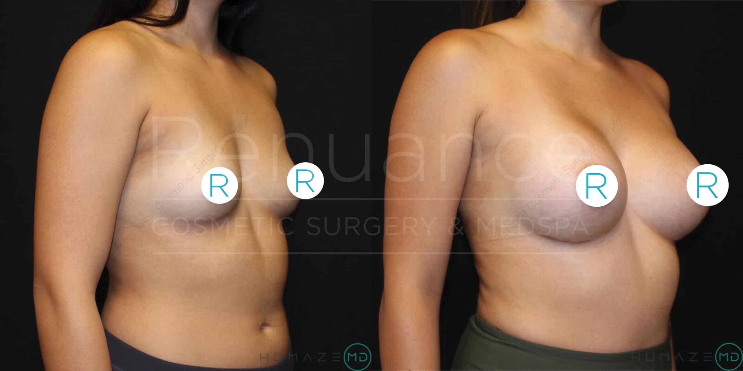 Two side-by-side images show the same woman before and after breast augmentation surgery. The left image is the "before" photo, featuring a side view of the woman with smaller breasts. The right image is the "after" photo, showcasing a side view with larger, enhanced breasts. The woman is wearing a dark-colored top in both photos. The background in both images is solid black, and there is text in the middle that reads, "Revance Cosmetic Surgery & MedSpa."