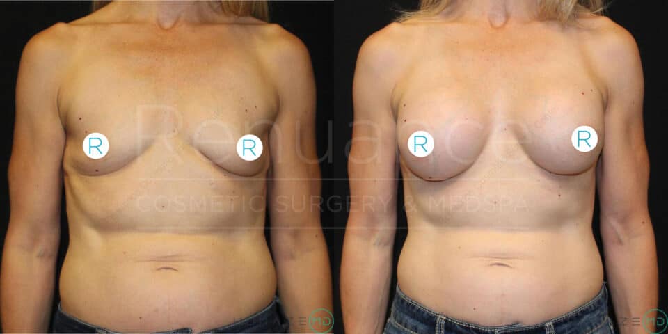 Two side-by-side images showing the same woman before and after breast augmentation surgery. In the "before" image on the left, the woman has smaller, natural breasts. In the "after" image on the right, the woman's breasts are noticeably larger and fuller. The person is wearing blue jeans in both photos. The images are watermarked with the text "Renaissance Cosmetic Surgery & MedSpa." The person's nipples are covered with circular stickers labeled "R."