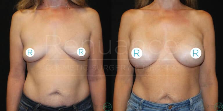 Two side-by-side images of a woman’s torso, showing a comparison of her chest area before and after a cosmetic surgery procedure. In the "before" image on the left, her breasts appear smaller and lack definition. In the "after" image on the right, her breasts are larger and more defined. The background is dark, and the images are labeled with the text "RENUANCE COSMETIC SURGERY & MEDSPA." Both images have a watermark with the letters "R"