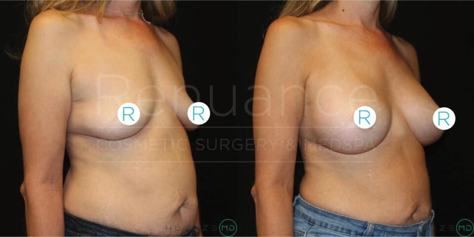 Side-by-side before and after images of a person who has undergone breast augmentation surgery. The left image shows the person before the surgery with smaller and sagging breasts. The right image shows the person after the surgery with fuller and lifted breasts. Both images are taken with the person wearing jeans, and light blue circular markers labeled "R" cover the nipples for modesty. The background is black and the overlay text reads "Pequance Cosmetic Surgery & Med Spa".