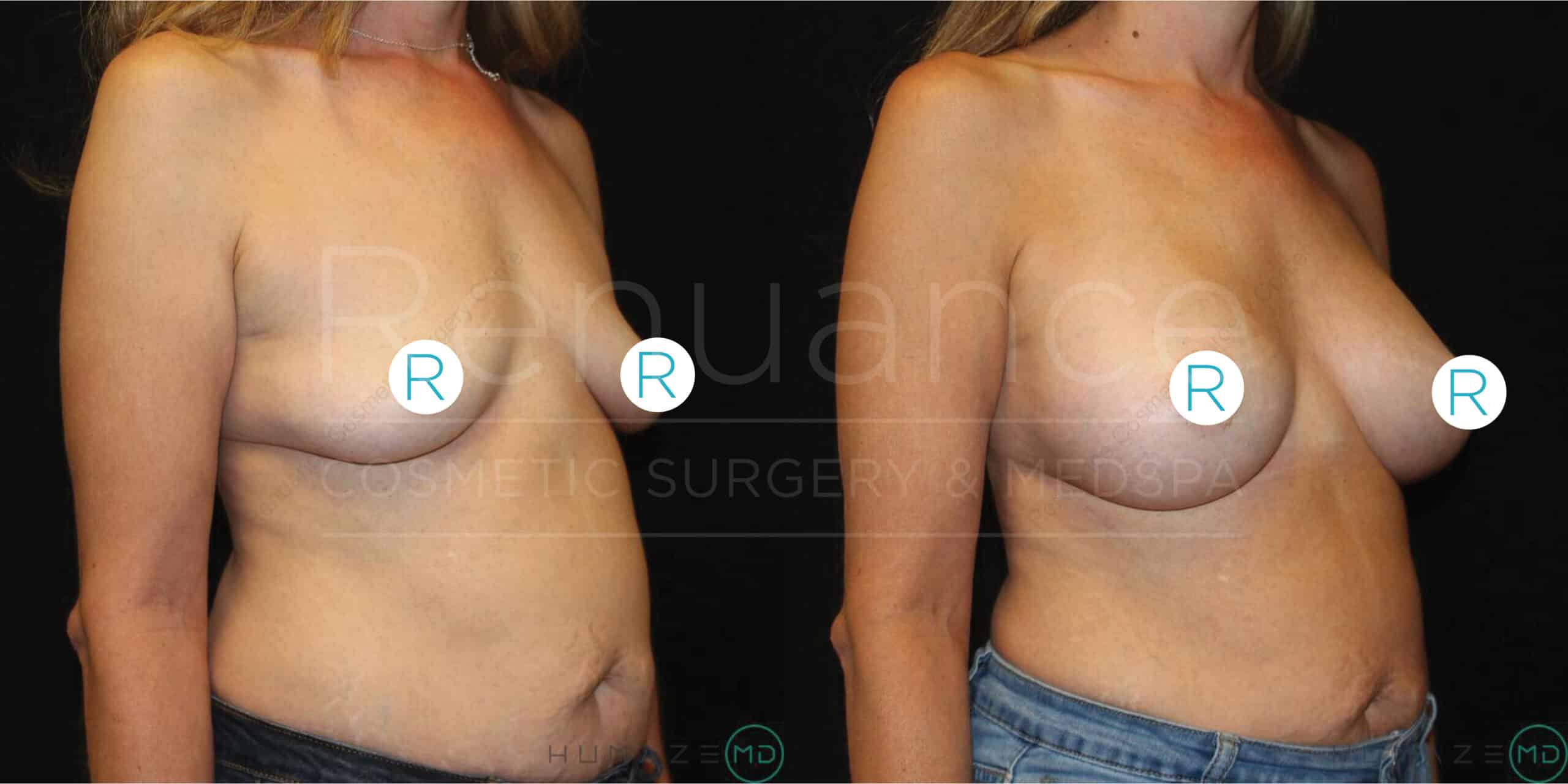 Side-by-side before and after images of a person who has undergone breast augmentation surgery. The left image shows the person before the surgery with smaller and sagging breasts. The right image shows the person after the surgery with fuller and lifted breasts. Both images are taken with the person wearing jeans, and light blue circular markers labeled "R" cover the nipples for modesty. The background is black and the overlay text reads "Pequance Cosmetic Surgery & Med Spa".