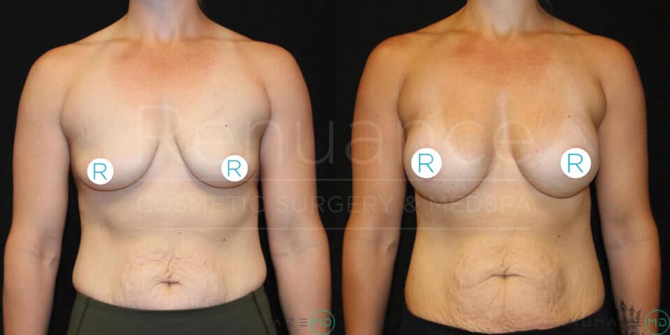 Side-by-side comparison of a person’s torso before and after a cosmetic surgical procedure. The left image shows the front view of the person's torso with smaller breasts, while the right image shows the same torso with noticeably larger breasts, indicating breast augmentation. Both images are taken against a black background, and white circles with the letter "R" are placed on each breast for reference. The words "Renuance Cosmetic Surgery & Med Spa" are faintly visible over the images.