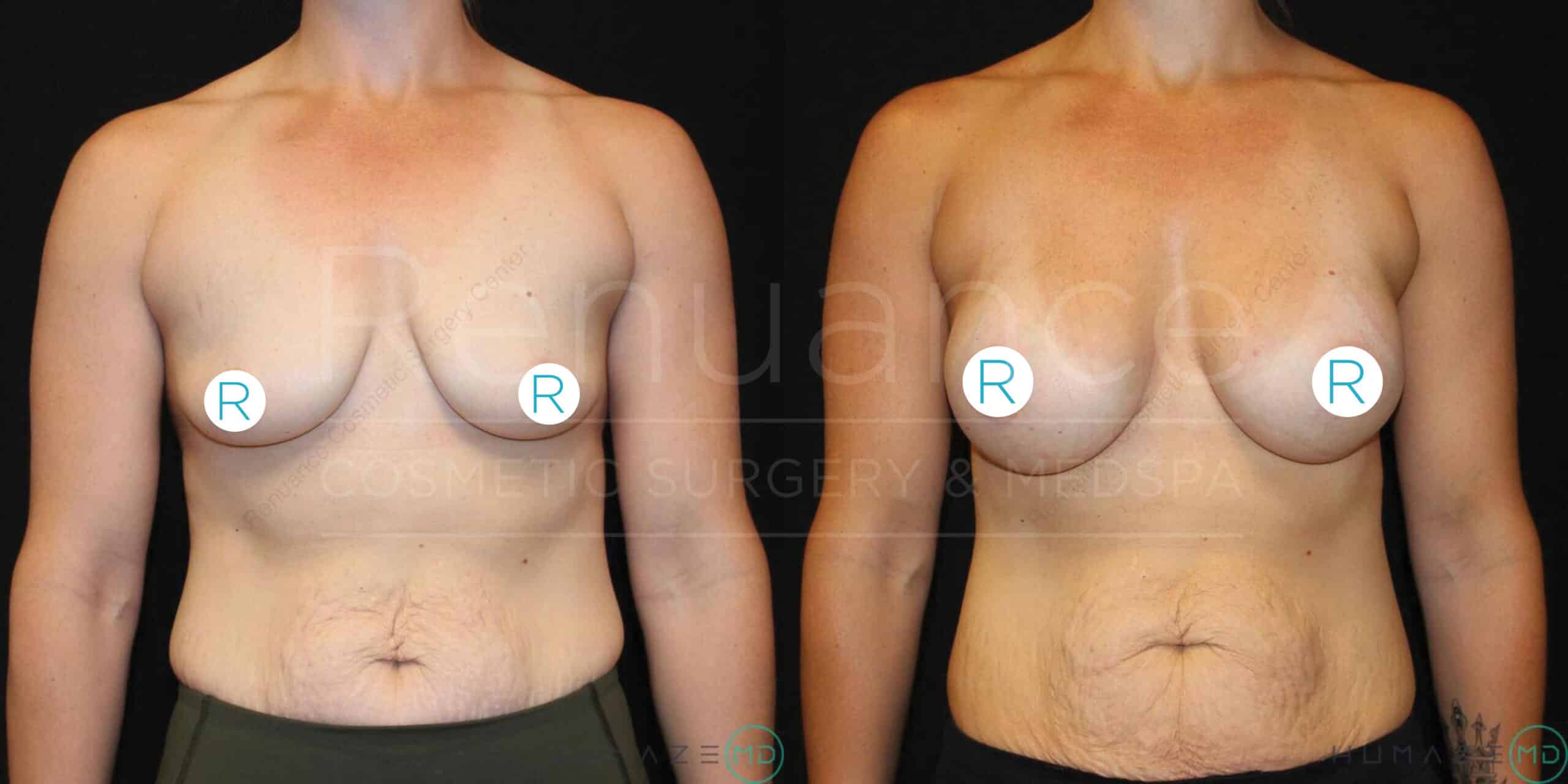 Side-by-side comparison of a person’s torso before and after a cosmetic surgical procedure. The left image shows the front view of the person's torso with smaller breasts, while the right image shows the same torso with noticeably larger breasts, indicating breast augmentation. Both images are taken against a black background, and white circles with the letter "R" are placed on each breast for reference. The words "Renuance Cosmetic Surgery & Med Spa" are faintly visible over the images.