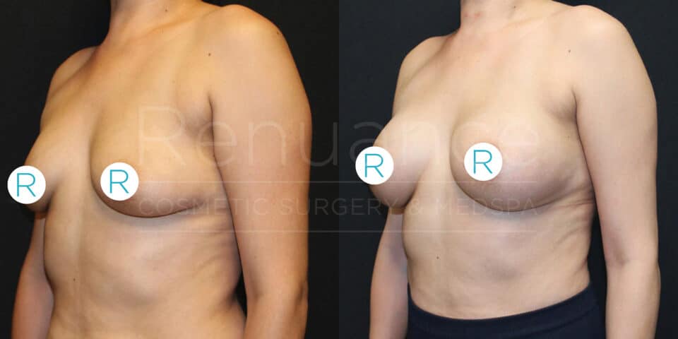 A side-by-side comparison of a woman's upper body showing the results of breast augmentation surgery. The left image depicts her body before the surgery, with smaller breasts, while the right image shows her body after the surgery, with noticeably larger and fuller breasts. Both images are taken against a dark background, and the woman's chest area is marked with "R" labels.
