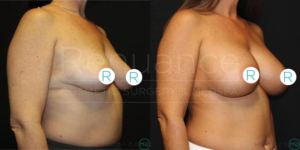 Side-by-side comparison images of a woman before and after a breast augmentation surgery. The left image shows the "before" state, with smaller breasts and the right image shows the "after" state, with larger, fuller breasts. The images are marked with "R" to indicate the right side, and the background is black. Text on the image says "Revance Cosmetics Surgery & Medspa."