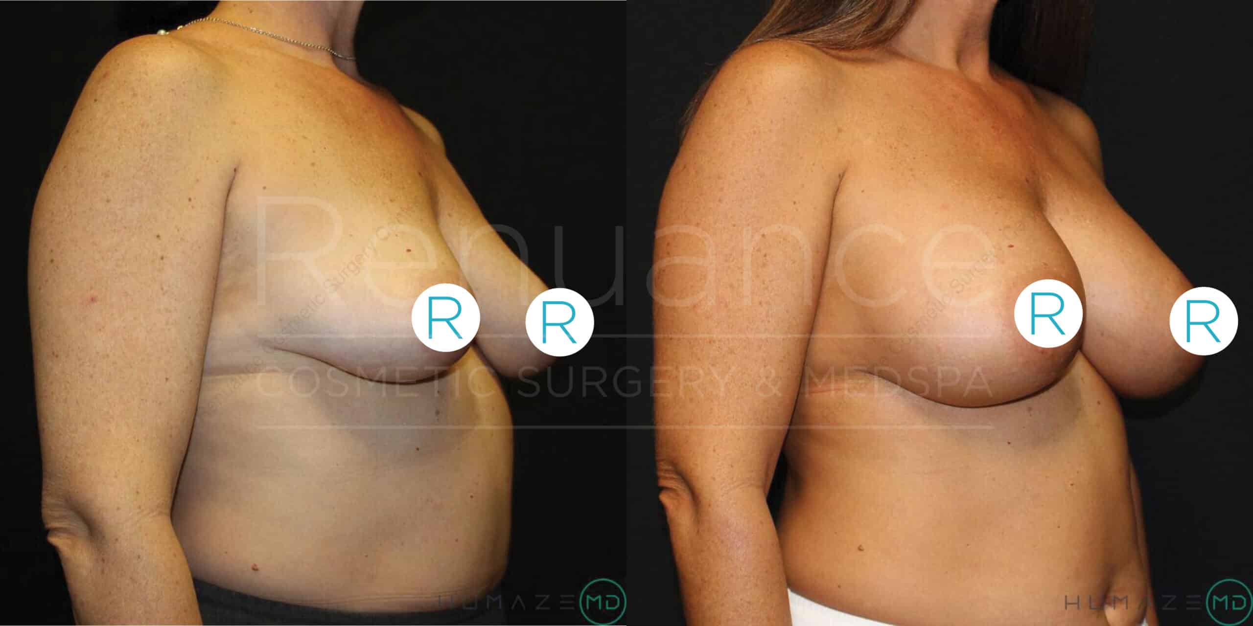 Side-by-side comparison images of a woman before and after a breast augmentation surgery. The left image shows the "before" state, with smaller breasts and the right image shows the "after" state, with larger, fuller breasts. The images are marked with "R" to indicate the right side, and the background is black. Text on the image says "Revance Cosmetics Surgery & Medspa."