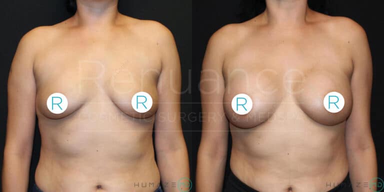 A before-and-after image of a woman showing the results of breast augmentation or lift surgery. On the left, the woman's breasts appear saggy and lower in position, while on the right, her breasts are lifted and fuller. The nipples are covered with "R" stickers in both images. The background is black, highlighting the changes in the subject's appearance.
