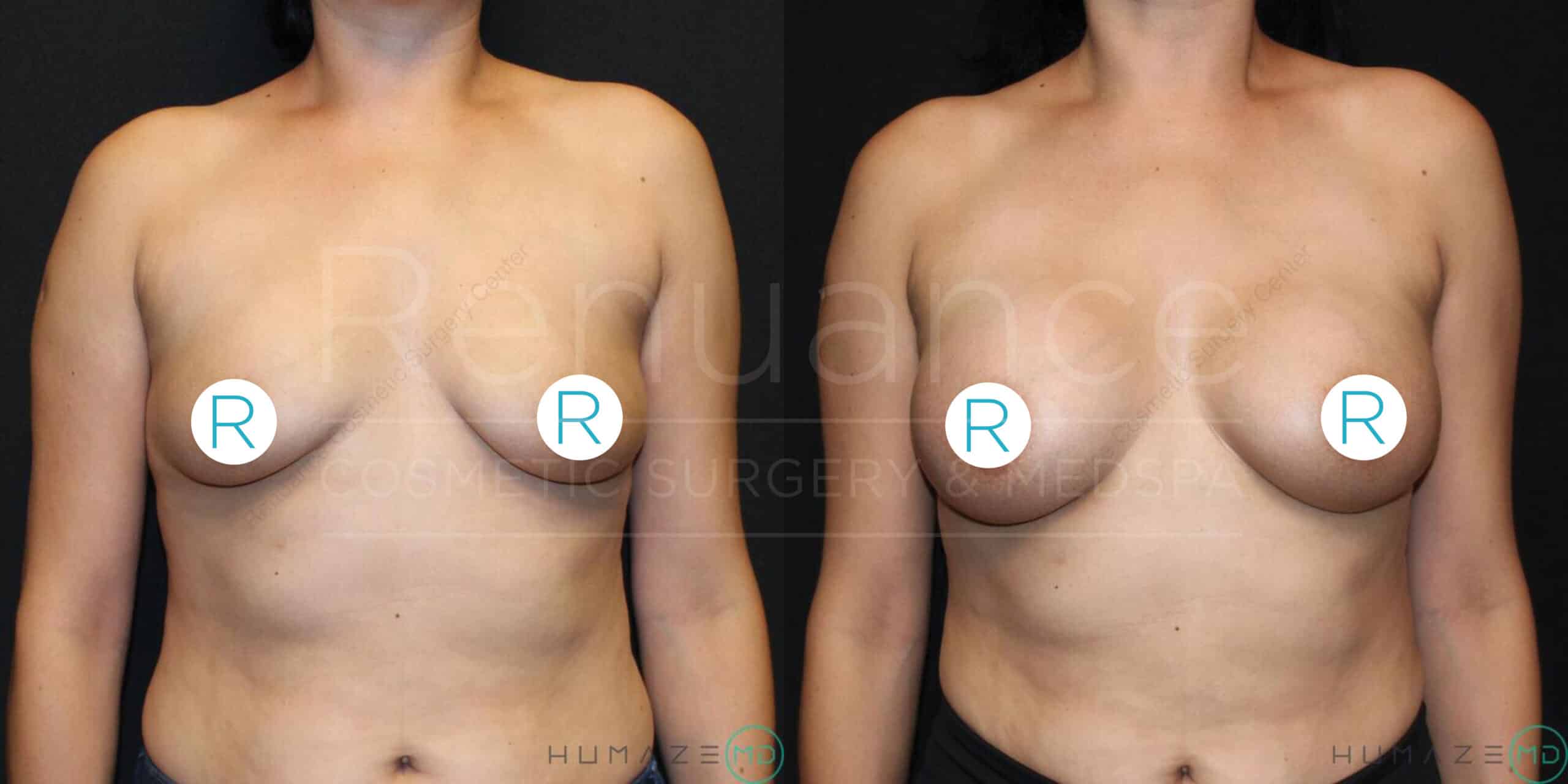 A before-and-after image of a woman showing the results of breast augmentation or lift surgery. On the left, the woman's breasts appear saggy and lower in position, while on the right, her breasts are lifted and fuller. The nipples are covered with "R" stickers in both images. The background is black, highlighting the changes in the subject's appearance.