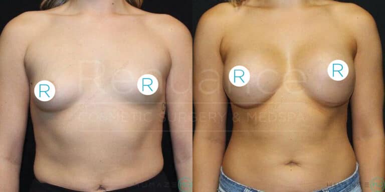 Two side-by-side images showing the same woman from the front, labeled "R" on both breasts. The left image displays her before breast augmentation surgery, and the right image shows her after breast augmentation, with visibly fuller breasts.