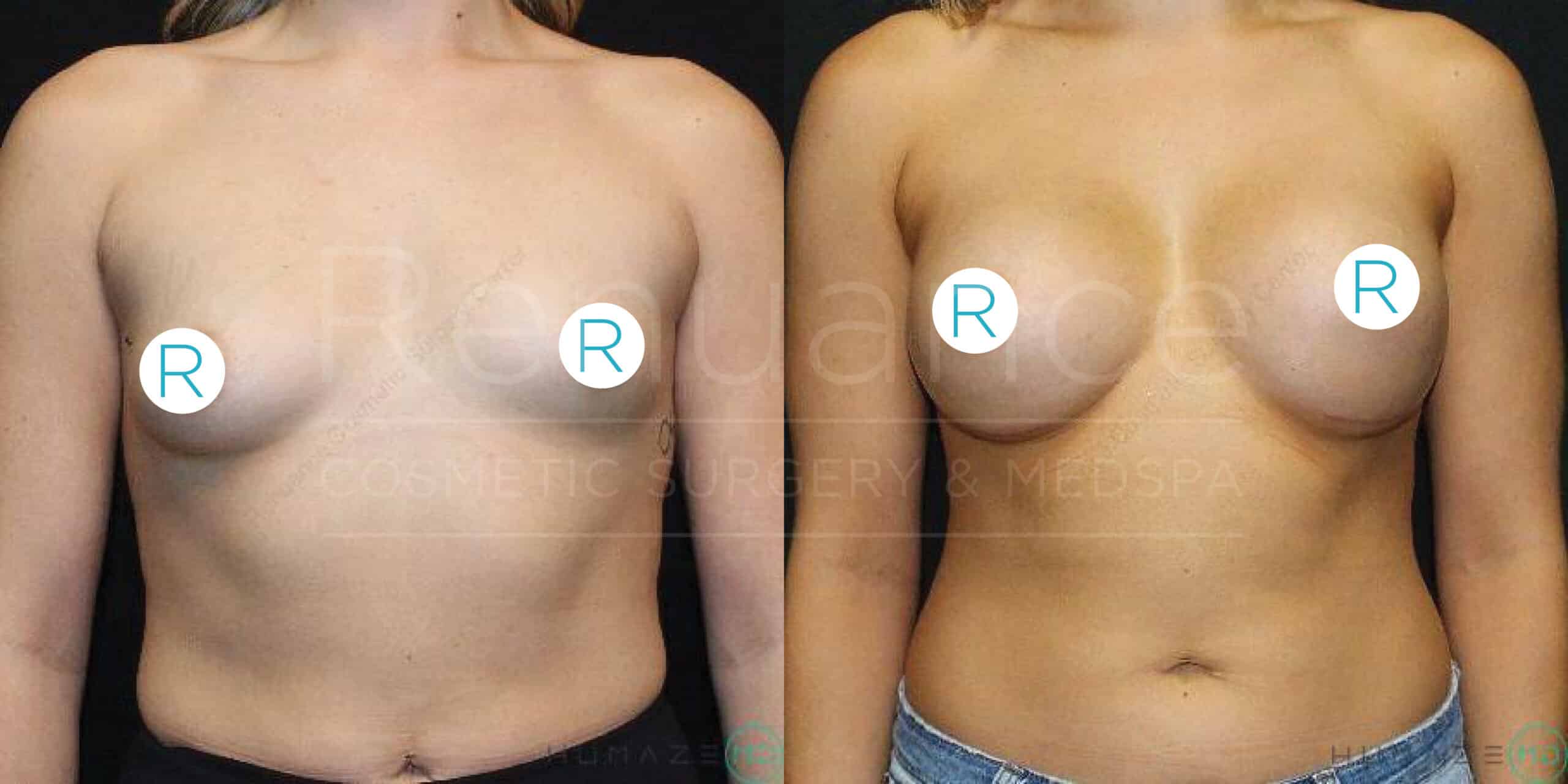 Two side-by-side images showing the same woman from the front, labeled "R" on both breasts. The left image displays her before breast augmentation surgery, and the right image shows her after breast augmentation, with visibly fuller breasts.
