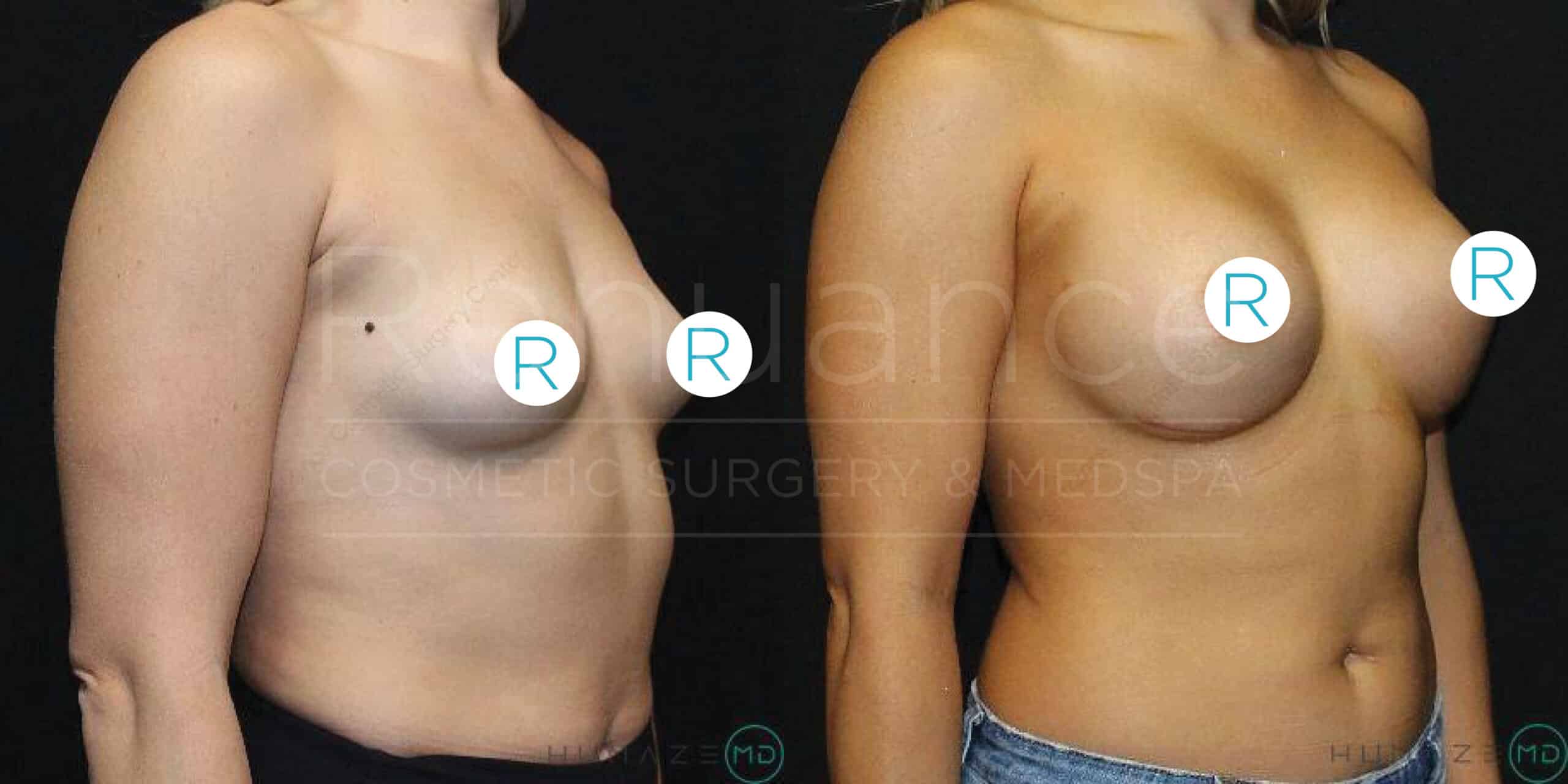Two side-by-side images show a woman's upper torso before and after breast augmentation surgery. In the "before" image on the left, her breasts appear smaller and less firm. In the "after" image on the right, her breasts are noticeably larger and more rounded, indicating the results of the augmentation. Both images have black backgrounds and labels with the letter "R" covering the nipples for modesty. The text "Radiance Cosmetic Surgery & Medspa" and a circular logo are visible across both