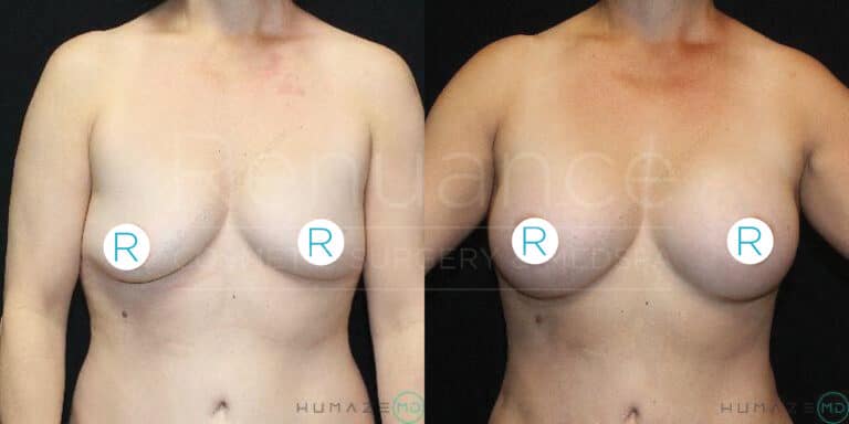 A before-and-after image showing the results of breast augmentation surgery on a woman. The image is divided into two sections: the left side shows the appearance of the breasts before surgery, and the right side shows the appearance after the surgery. Both images display the woman from the front, with her arms at her sides. The letters "R" are placed over the nipples to maintain modesty.