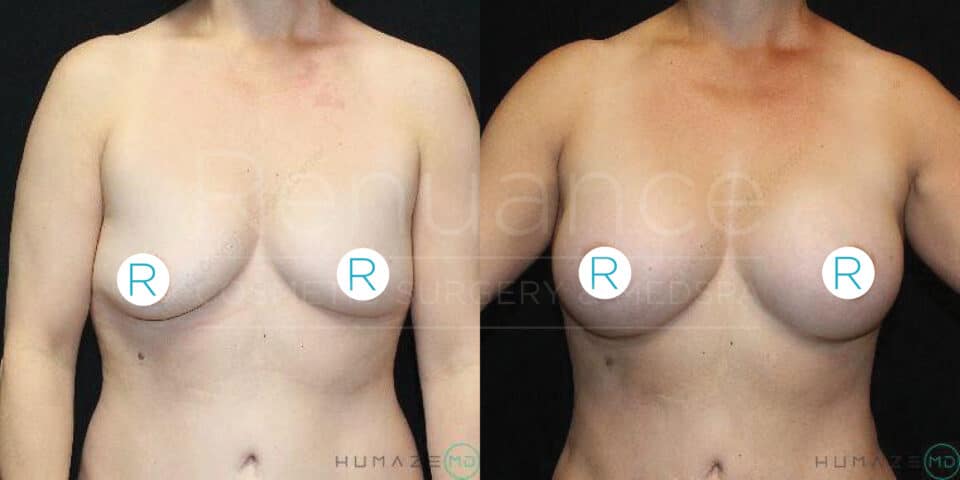 A before-and-after image showing the results of breast augmentation surgery on a woman. The image is divided into two sections: the left side shows the appearance of the breasts before surgery, and the right side shows the appearance after the surgery. Both images display the woman from the front, with her arms at her sides. The letters "R" are placed over the nipples to maintain modesty.