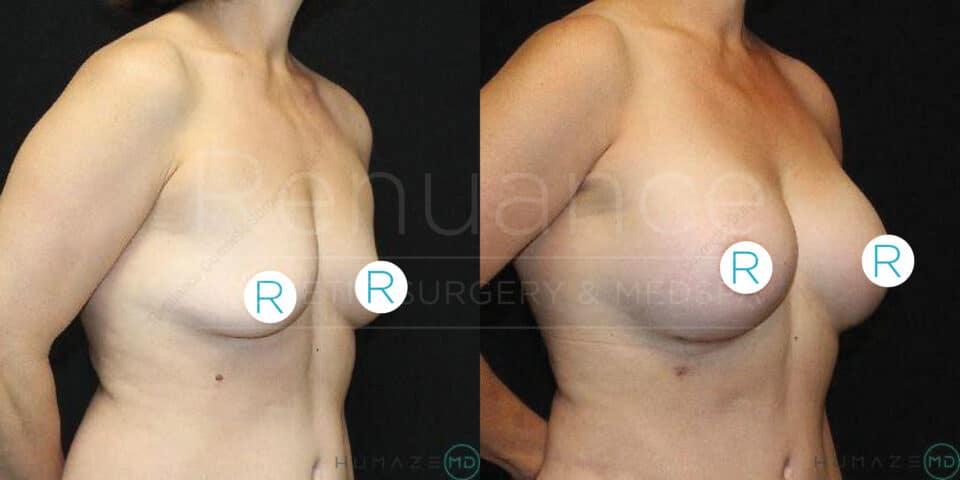 "Side-by-side images showing a woman's upper body before and after breast augmentation surgery. The image on the left depicts the pre-surgery state with smaller breasts, while the image on the right shows the post-surgery state with larger, fuller breasts. Both images have marked the right breast with the letter 'R'."