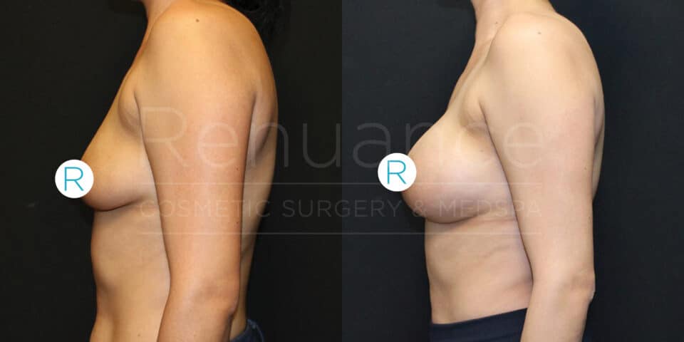 Side-by-side comparison image showing the profile views of a woman's torso before and after breast augmentation surgery. The left side shows the body before the procedure, with smaller breasts, while the right side shows the post-surgery results, with noticeably larger and fuller breasts. The background is black, and watermarks or text overlays are visible on the image.