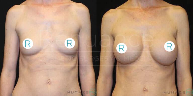 Two side-by-side images show a person's torso before and after a medical procedure. The image on the left shows the torso before the procedure, while the image on the right shows the torso after the procedure. The "R" symbols on the chest in both images indicate the location of the procedure. Both images have the same background and branding text that reads "Recouance Cosmetic Surgery & Medspa" and "Humaze".