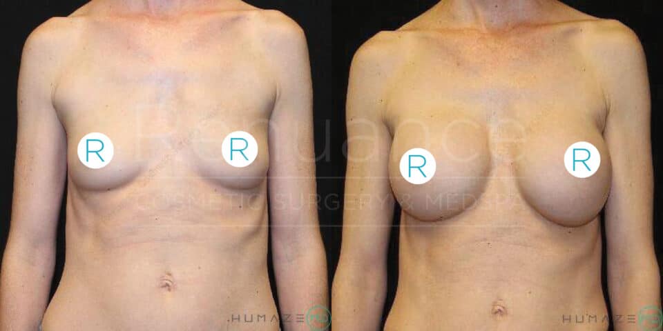 Two side-by-side images show a person's torso before and after a medical procedure. The image on the left shows the torso before the procedure, while the image on the right shows the torso after the procedure. The "R" symbols on the chest in both images indicate the location of the procedure. Both images have the same background and branding text that reads "Recouance Cosmetic Surgery & Medspa" and "Humaze".