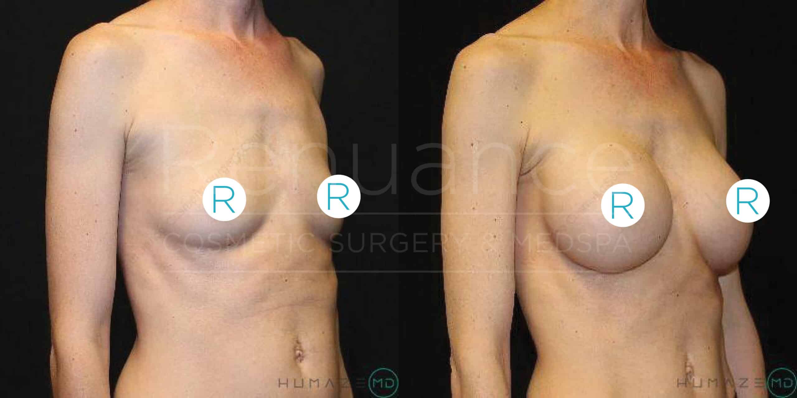 A side-by-side comparison image showing the results of a breast augmentation procedure. The left side depicts a person's chest before the surgery, displaying a flat chest. The right side shows the same person after the surgery, with noticeably larger and fuller breasts. The background is a plain, dark color.
