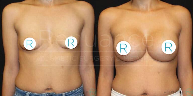 A side-by-side comparison of a person's upper torso before and after breast augmentation surgery. The image on the left shows a person with smaller breasts, and the image on the right shows the same person with larger, fuller breasts post-surgery. Both images are taken against a black background, with the subject standing in the same position. The nipples are covered with white circles marked with an "R."